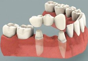 protesis-dental-fija